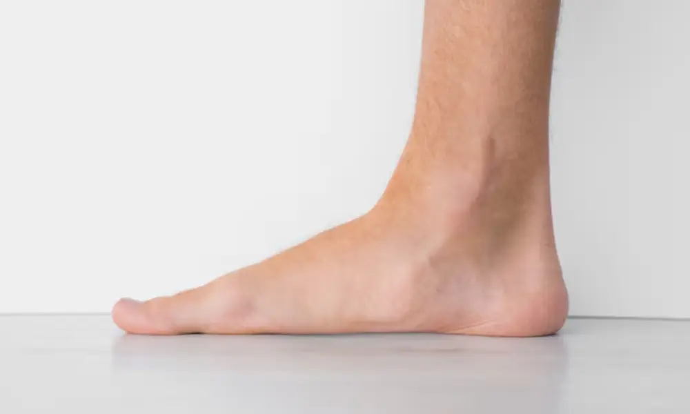 Piedi piatti negli adulti: cause, sintomi e trattamenti